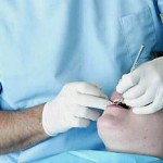 Implantologia Dentale Ciampino Roma " Pantaleone "